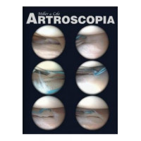 ARTROSCOPIA