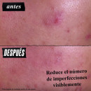 Gently Effective Blemish-Targeting
Tratamiento Limpiador Acné