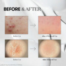 Reedle Shot 100
TRATAMIENTO con Microagujas Glow Effect  VT COSMETICS