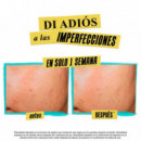 Expertly Clear Blemish-Treating & Preventing Lotion