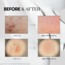 Reedle Shot 300
Tratamiento Facial Intensivo Renovador