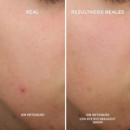 IT COSMETICS Serum Anti-acné, 30ML