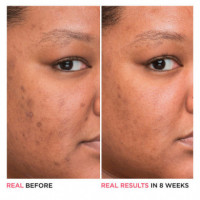 Bye Bye Dark Spots Niacinamide Serum  IT COSMETICS